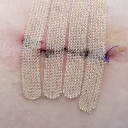 Image of cut with stitches and bandages