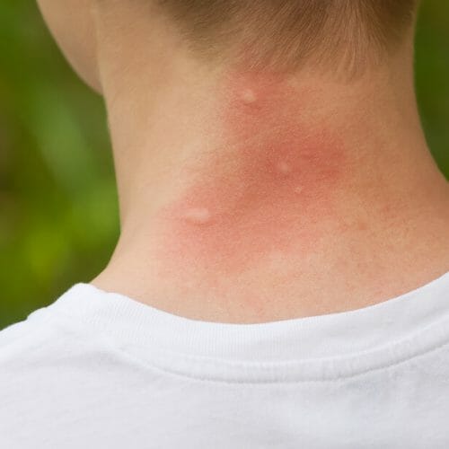 bug bites on the back of person's neck