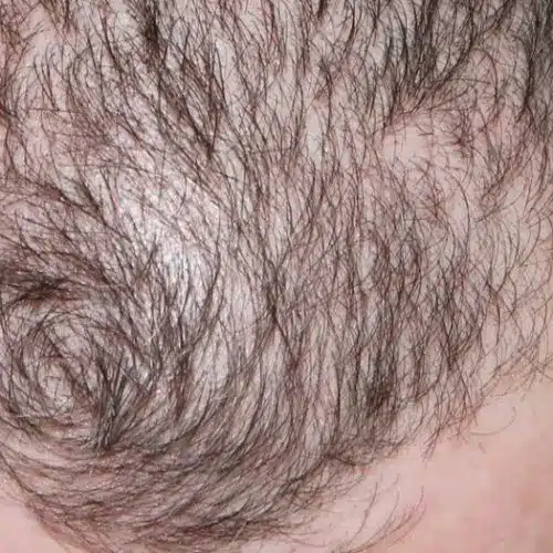 An Introduction To Hair Loss - Tanner Clinic