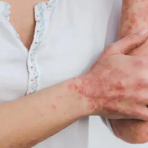Woman with skin irritation on her hands and forearms